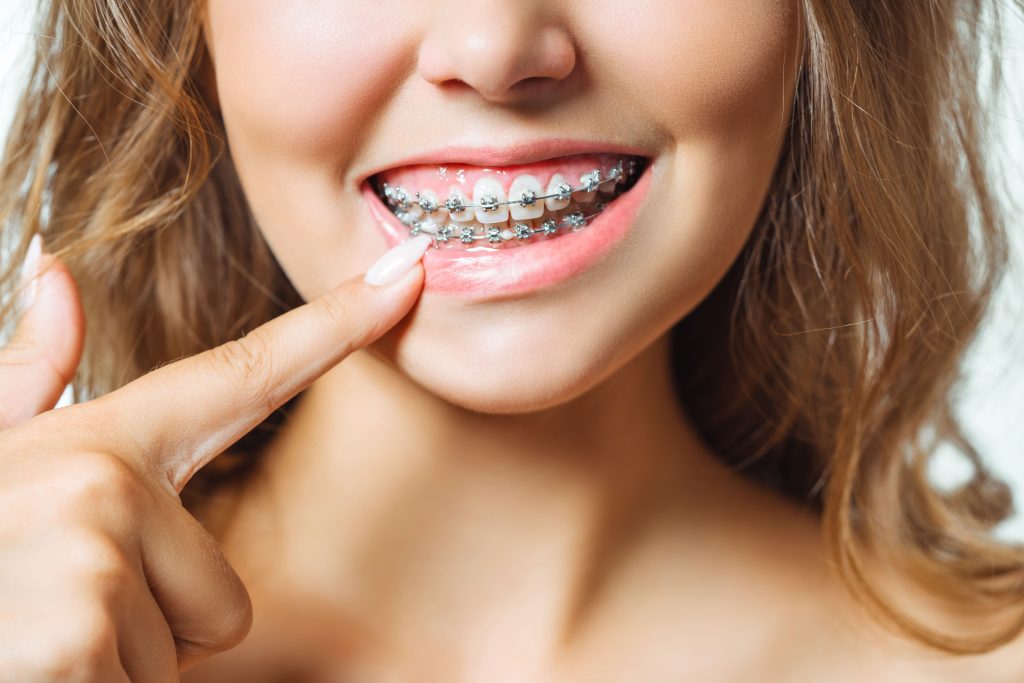 Carillas dentales con dientes torcidos? - Raga Ortodoncia