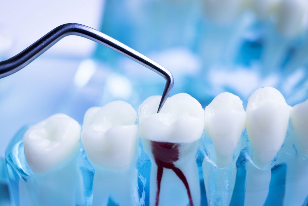 Endodoncia: Consecuencias de no terminar correctamente un tratamiento