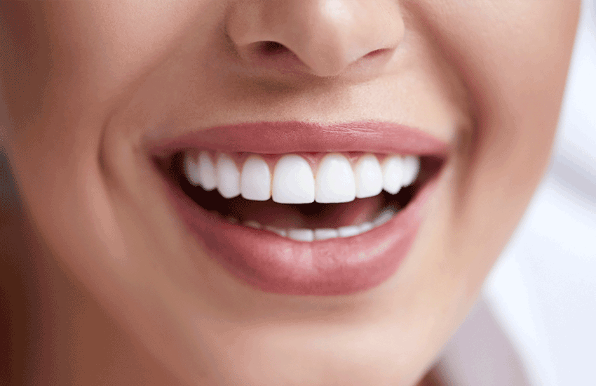 Consejos para el mantenimiento de las carillas dentales