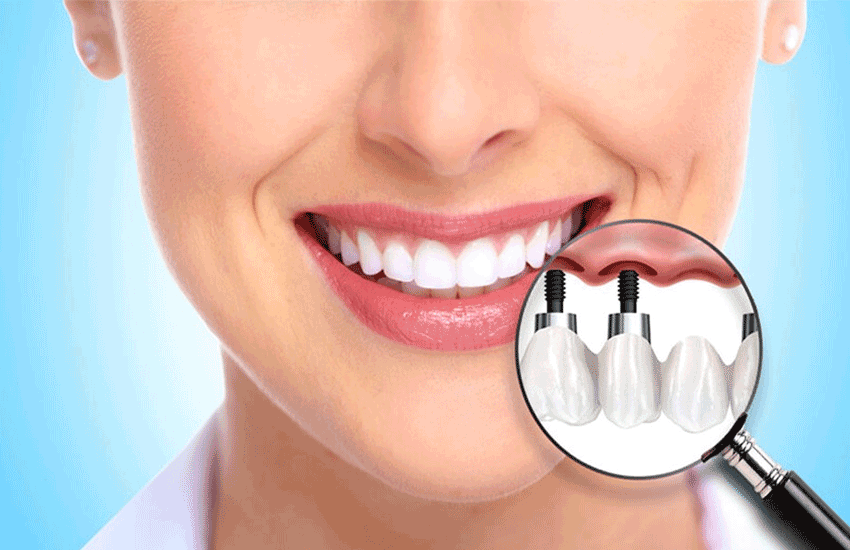 Enfermedades Relacionadas con los Implantes Dentales