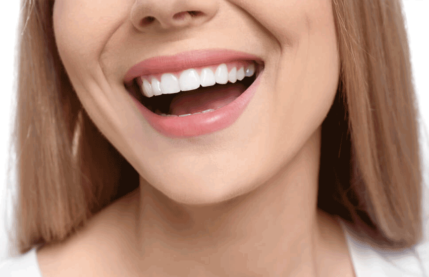 ¿Qué es el Mantenimiento de las Carillas Dentales?