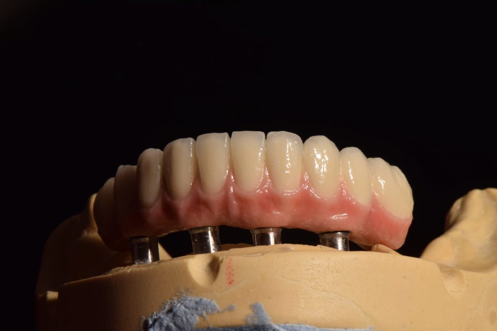 prótesis dentales híbridas