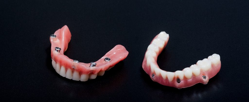 tipos de prótesis dentales