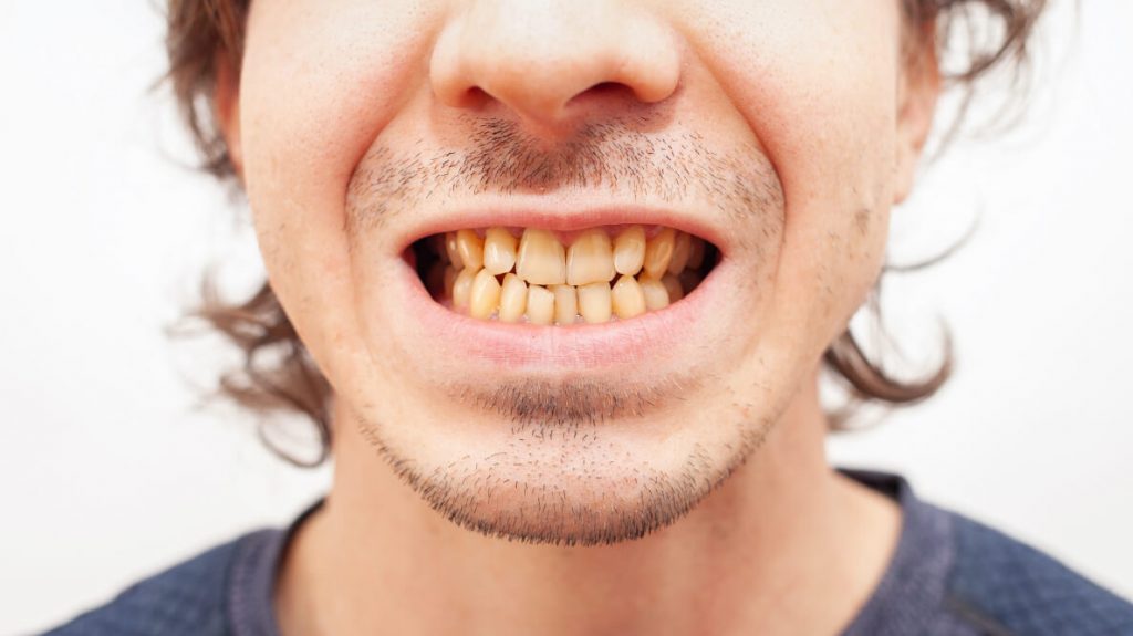 5 razones por las que los dientes se ponen amarillos