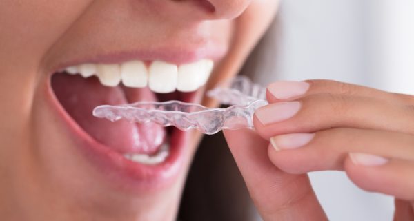 5 razones para usar protectores dentales