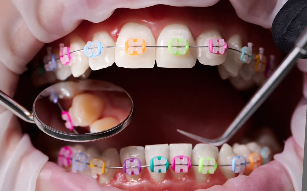 razones para usar ortodoncia