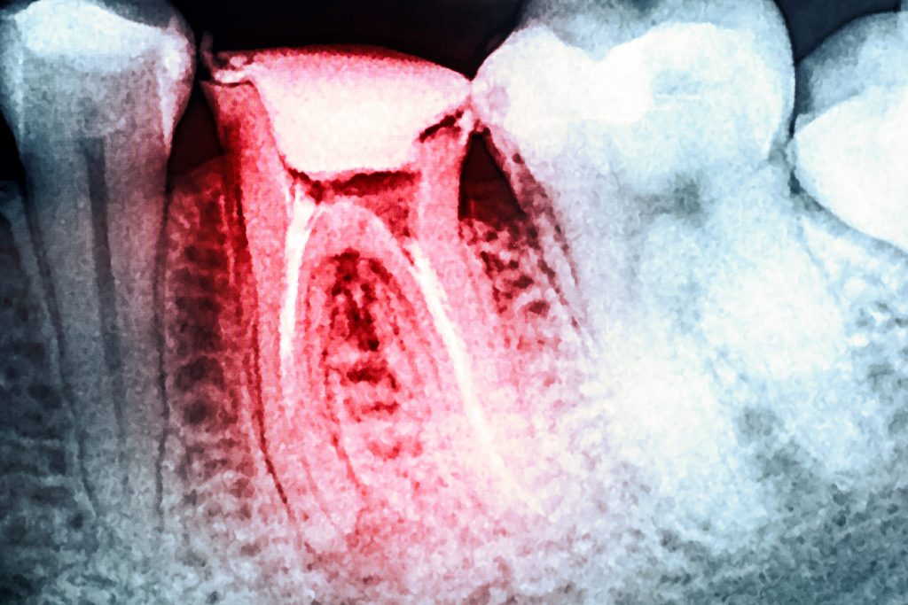 Qué es la endodoncia