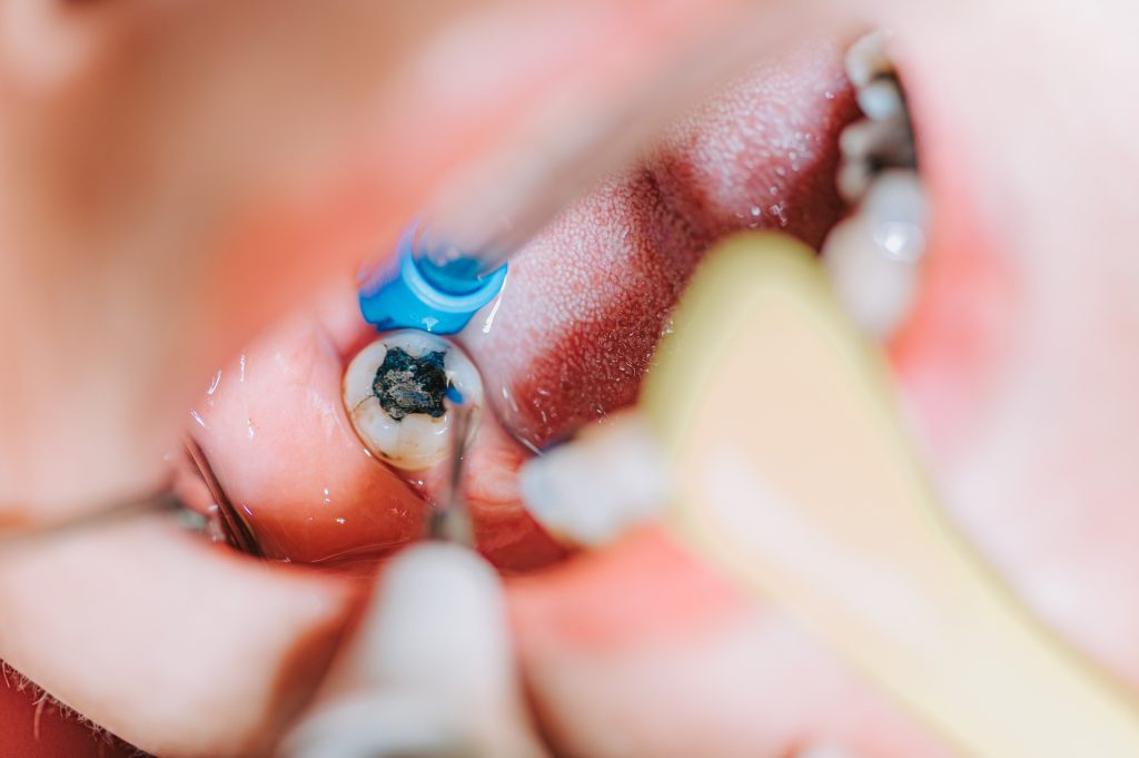 Procedimiento de endodoncia 