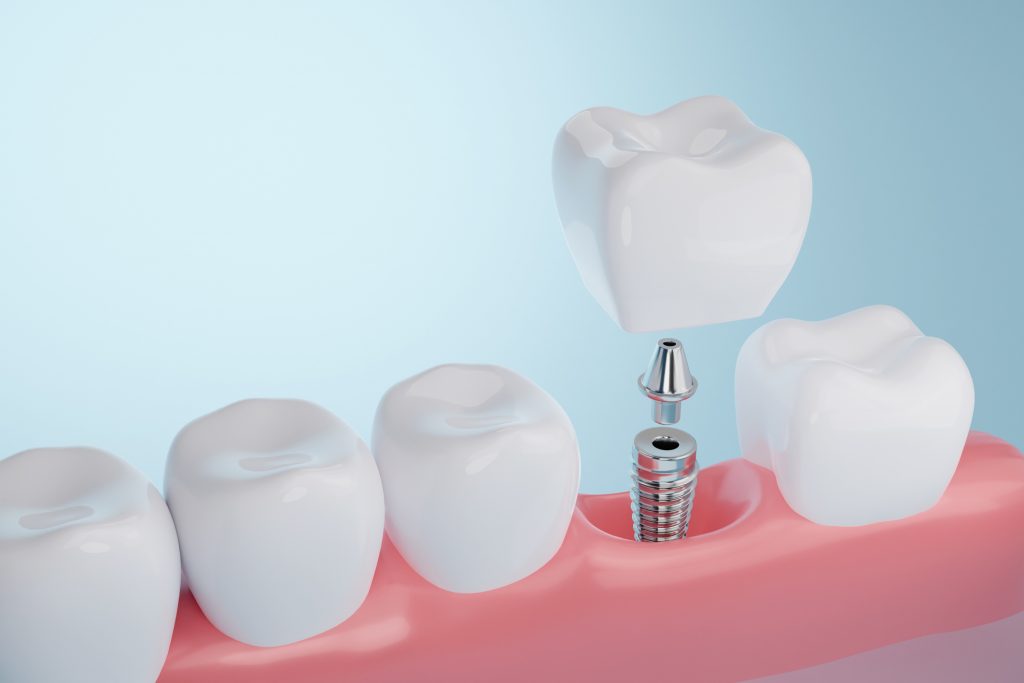 Proceso de implante dental