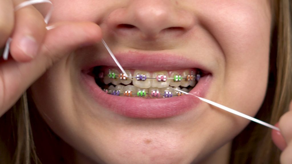 Persona con brackets dentales usando hilo dental