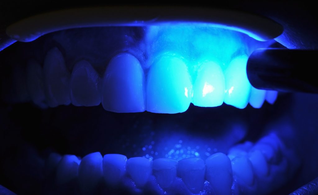 Sellando las resinas dentales con luz ultravioleta
