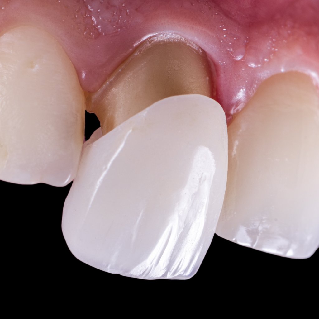 Carillas dentales como alternativas a los brackets