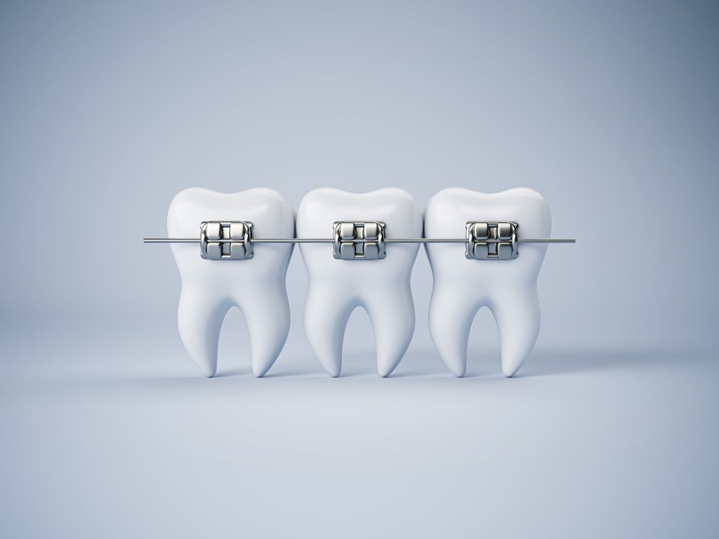 imagen de dientes con brackets