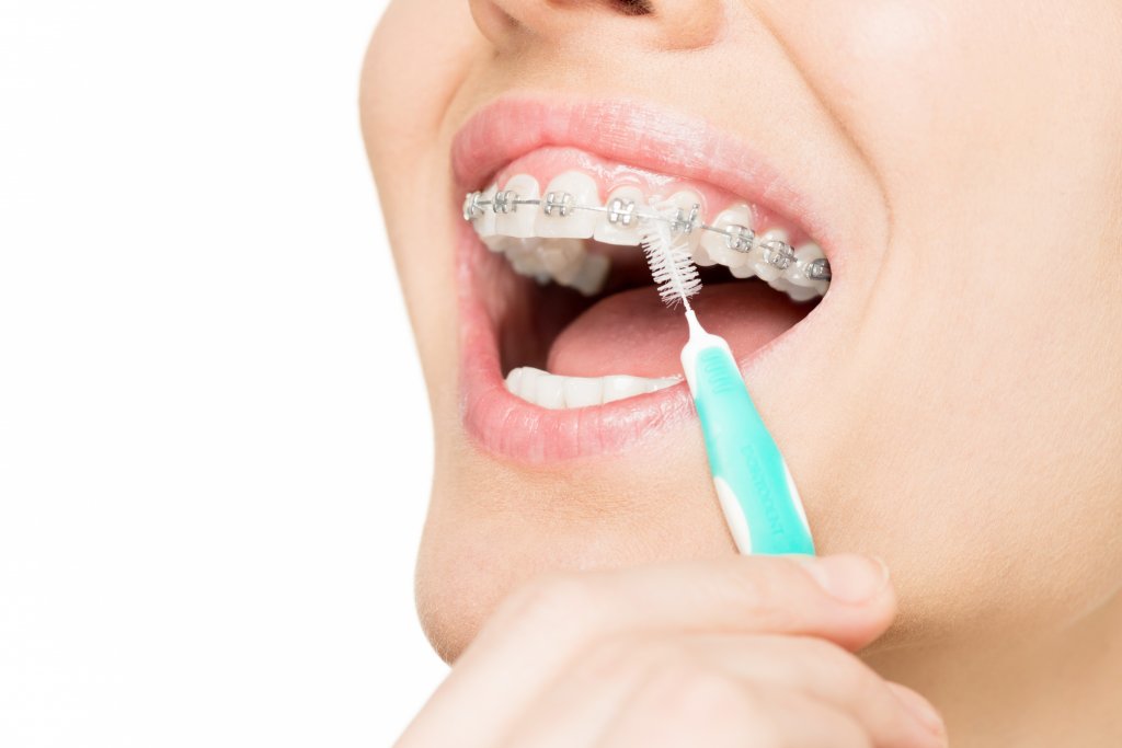 Limpieza de dentadura con ligas en los brackets