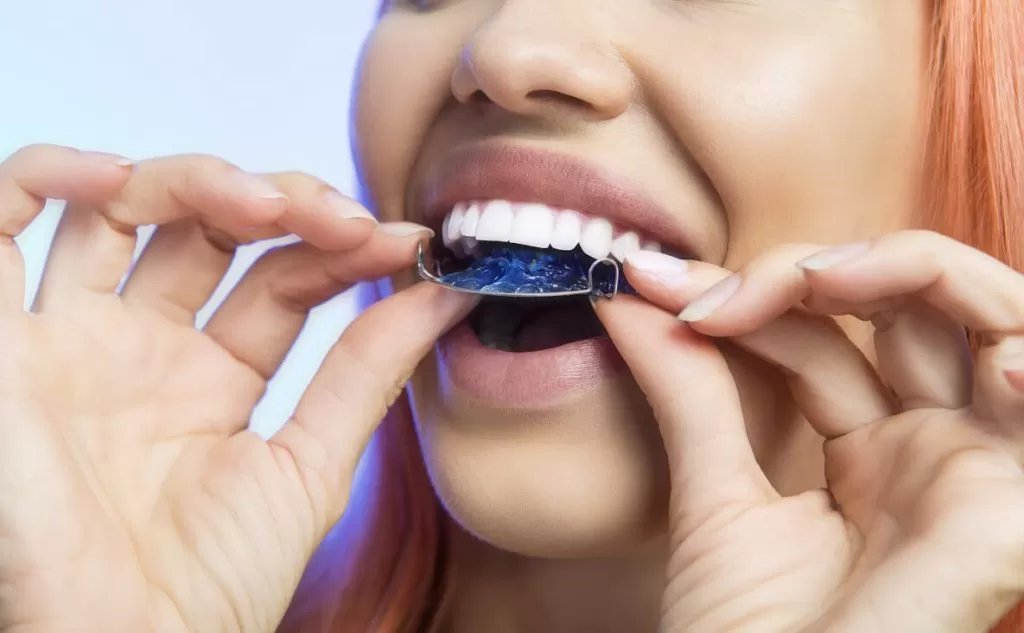 Alternativa a los brackets dentales