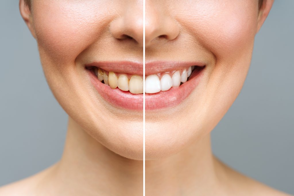 Imagen de sonrisa, con comparativa del antes y después del blanqueamiento dental 