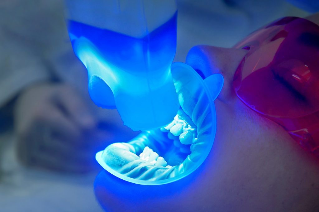 Blanqueamiento dental en consultorio con luz led 