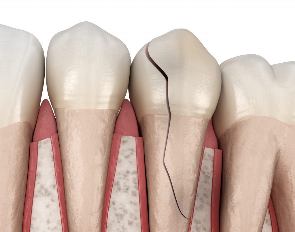 Ilustración de fractura dental vertical