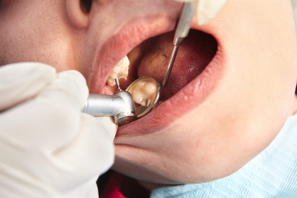 odontología mínimamente invasiva para combatir caries incipientes