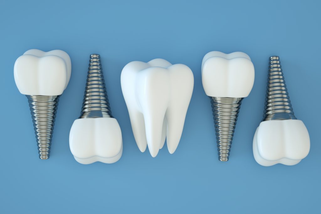 Implantes dentales en fondo azul