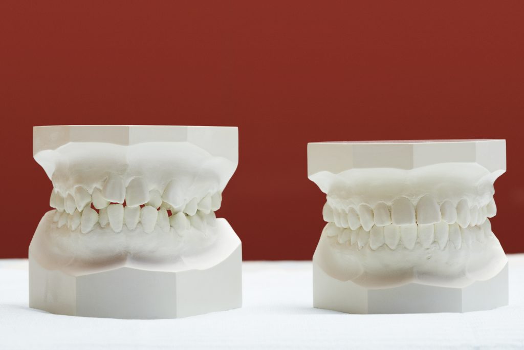 Moldes dentales que muestran el antes y después de los alineadores dentales en una dentadura