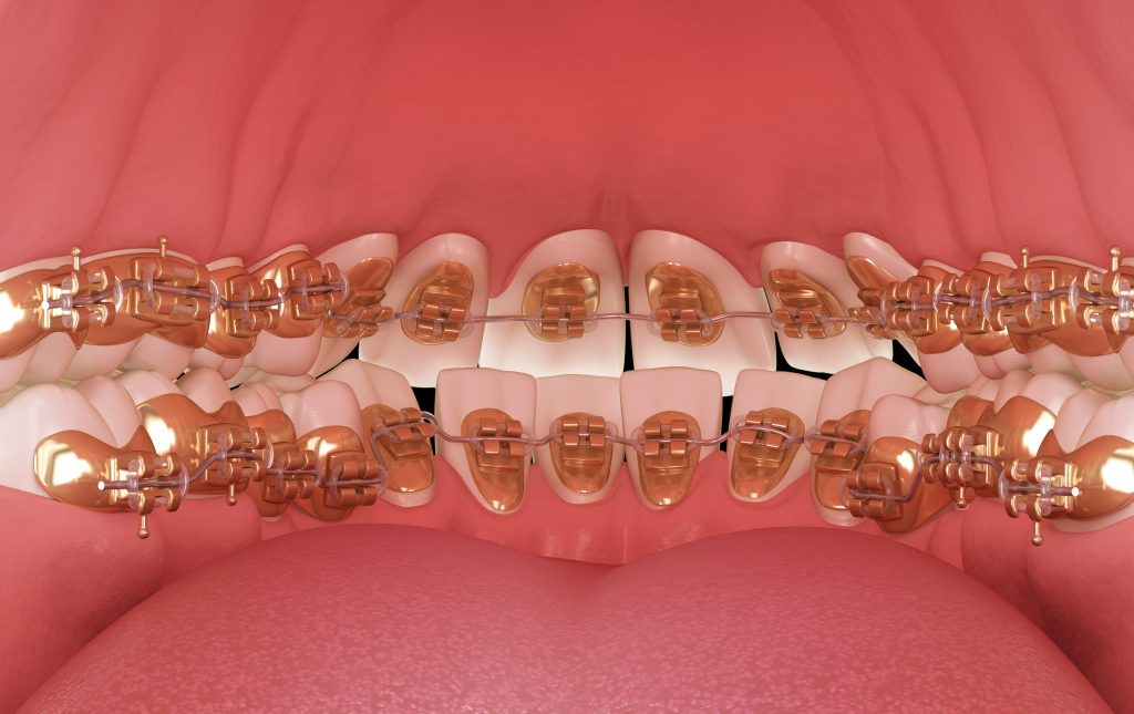 Vista interna de la boca, con brackets linguales