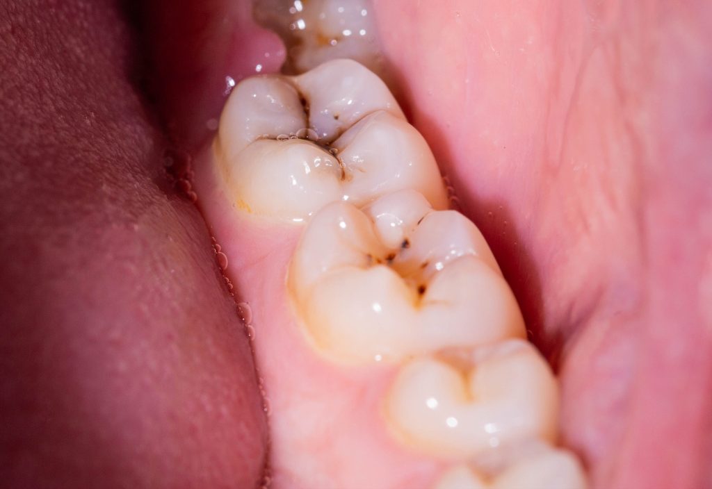 Close up a caries dentales 